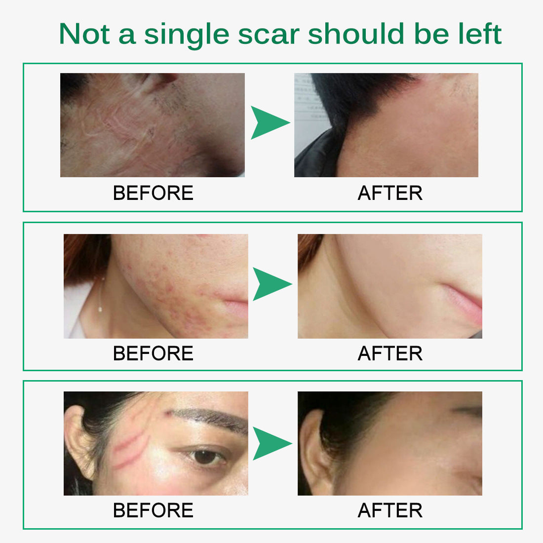 Crema viso Skin Rebound Scarless, cicatrici, cicatrici da acne, smagliature